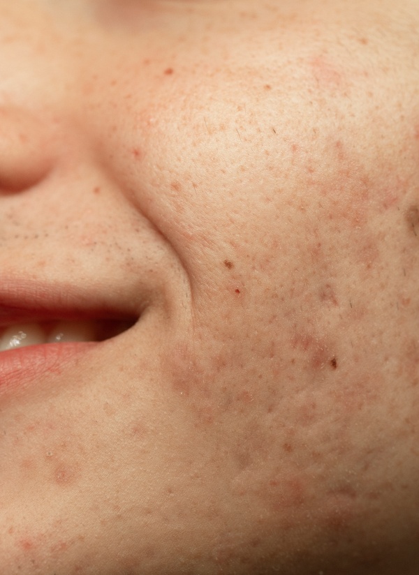 Visage d une jeune femme avec de l acne sur ses joues J ai de l acne| Dr Khalifa Montauban