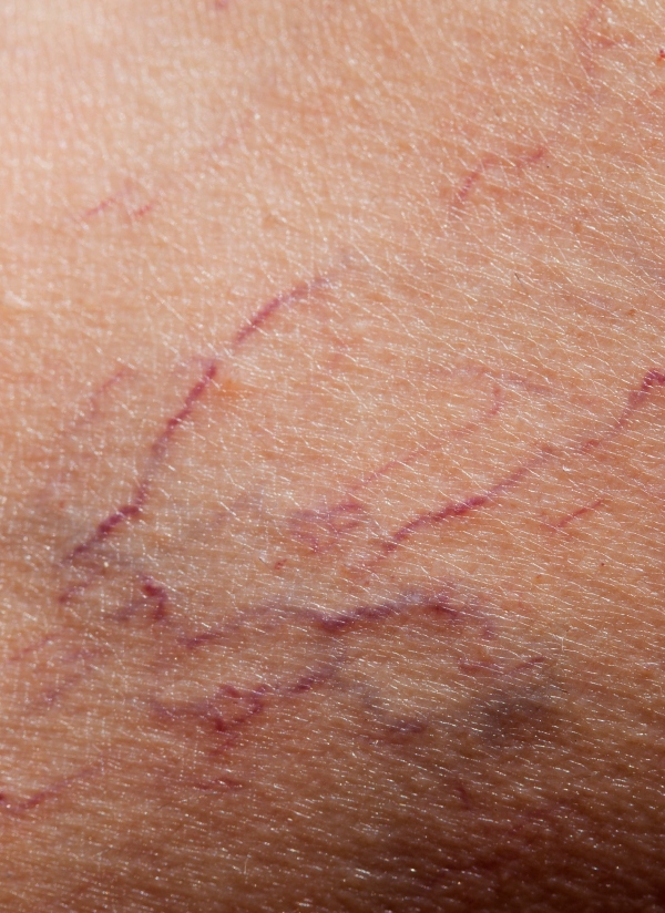 Photo de peau montrant une couperose laser vasculaire | Dr Khalifa Montauban